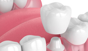 Dental Crowns