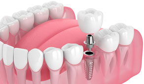 Dental Implants