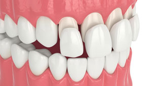 Porcelain Veneers